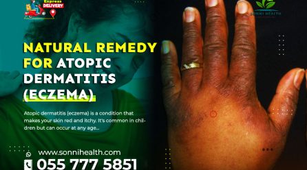 NATURAL REMEDY FOR ATOPIC DERMATITIS (ECZEMA)