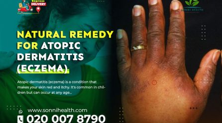 NATURAL REMEDY FOR ATOPIC DERMATITIS (ECZEMA)