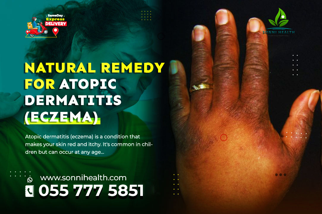 NATURAL REMEDY FOR ATOPIC DERMATITIS (ECZEMA)