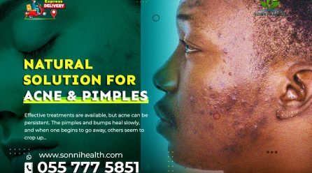 NATURAL SOLUTION FOR ACNE & PIMPLES
