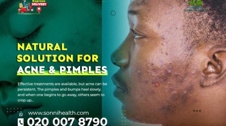 NATURAL SOLUTION FOR ACNE & PIMPLES