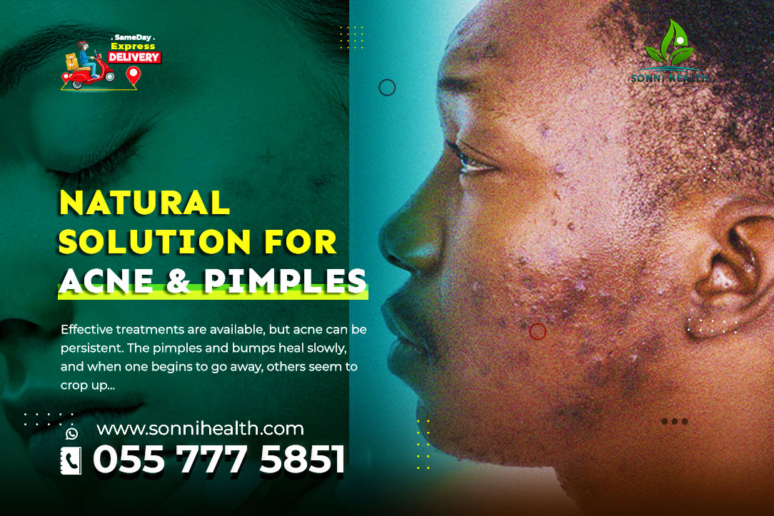 NATURAL SOLUTION FOR ACNE & PIMPLES
