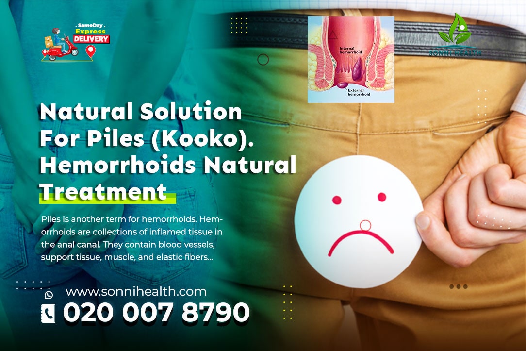 NATURAL SOLUTION FOR HEMORRHOIDS (PILES) – PERMANENT TREATMENT FOR BOTH INTERNAL & EXTERNAL HEMORRHOIDS(PILES)