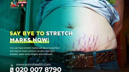 SAY BYE TO STRETCH MARKS NOW