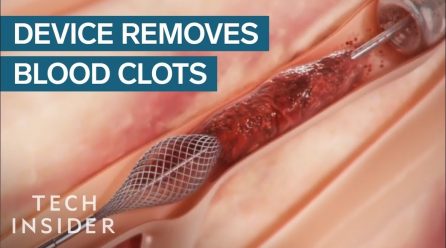 HOW TO PREVENT BLOOD CLOTS NATURALLY WITH NO SIDE EFFECTS