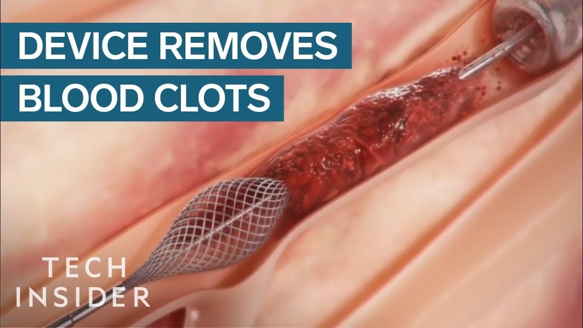HOW TO PREVENT BLOOD CLOTS NATURALLY WITH NO SIDE EFFECTS